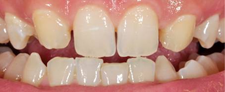Facings case 1: voor
